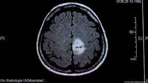 فیلم رادیولوژی تومور مغزی